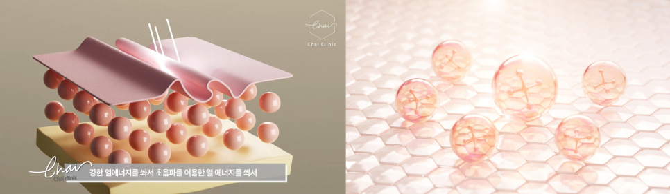 연남동피부관리 울쎄라, 써마지... 정답은 울써마지? 관련 이미지 5