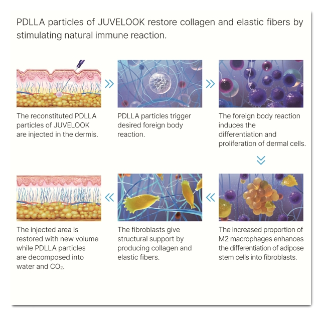 Three Ways to Prevent Juvelook Nodules and Side Effects in Hongdae image 6