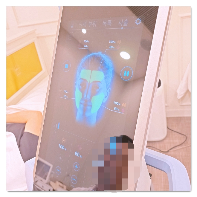 How to Reduce the Midface with EMFACE: A Midface Reduction Procedure image 6