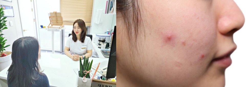 이대역피부관리 지긋지긋한 여드름, 굿바이 하세요 관련 이미지 2
