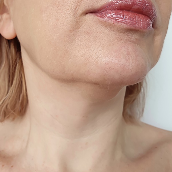 Hongdae Thermage or Ulthera: Which Is Right for My Skin? image 4