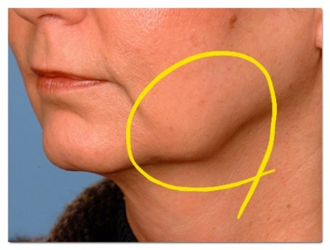 Two Ways to Get Botox in Mapo at a Good Value image 5