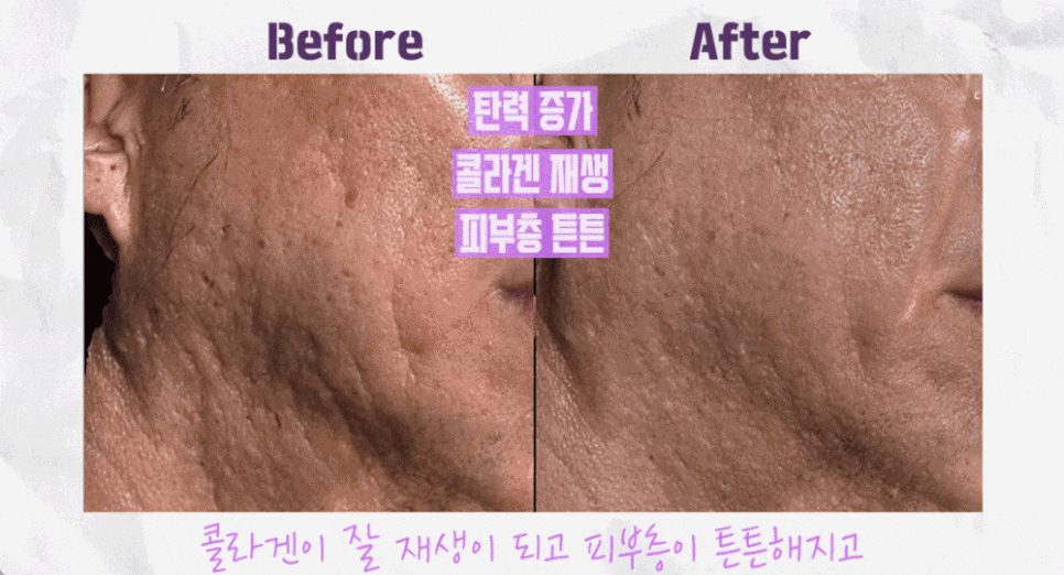 여드름 흉터 레이저, 피코프락셀과 같이 하면 좋은 것은? 관련 이미지 8