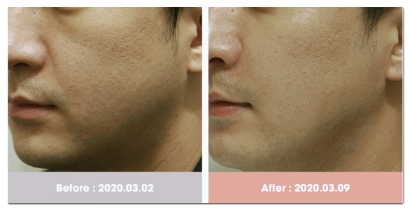Why Do Nasolabial Fold Filler Prices Vary by Clinic? image 3