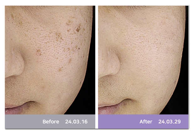 How Does Dual Toning Differ from Regular Laser Toning? image 4