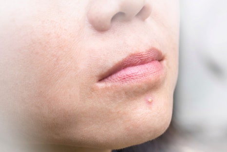 작은입술필러 자연스러운 아름다움을 디자인 방법? 관련 이미지 5