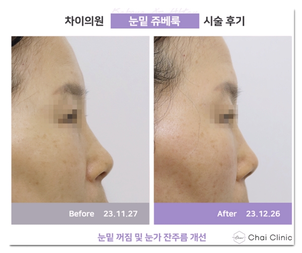 합정 쥬베룩, 결절 걱정없이 효과 보는 방법 (경험 많은 곳을 찾아야 하는 이유) 관련 이미지 9