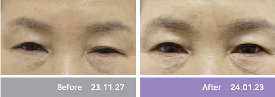 Why Iseurf Uses a Dedicated Eye-Area Tip for Wrinkles Around the Eyes image 12