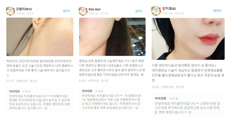 관자놀이보톡스 큰바위얼굴 고민해결 관련 이미지 15
