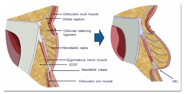 Causes of and Solutions for Side Effects After Thread Lifting in Hongdae image 3
