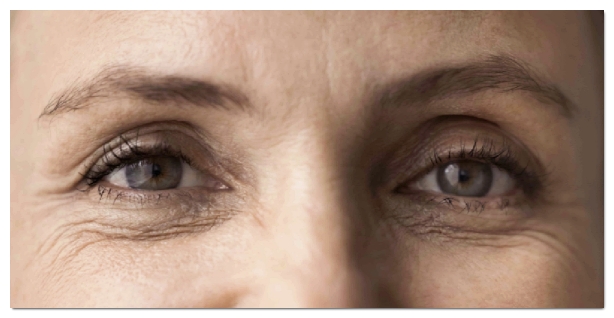 Differences and Effect Comparison Between Eye Thermage and Eye Ultherapy image 9
