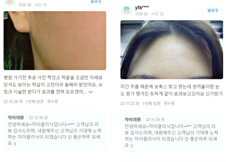토르리프팅 통증과 부작용은 낮추며 효과는 최대로! 관련 이미지 17