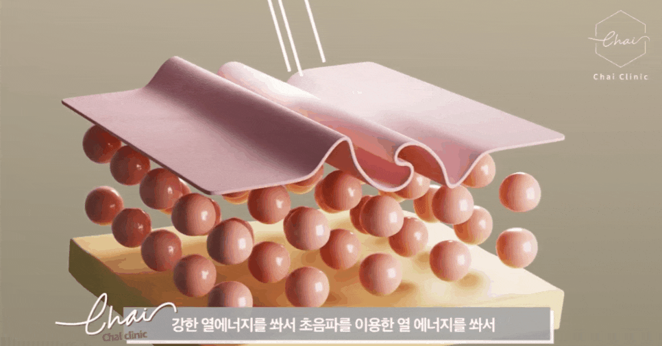 피부관리레이저종류 합정 울써마지까지 한방에 정리! 관련 이미지 13