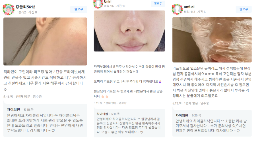 사각보톡스 불룩한 턱선을 V라인 얼굴로 관련 이미지 14