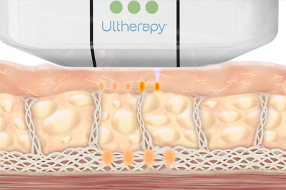 3 Key Points to Know Before Going for Ulthera in Hongdae image 14