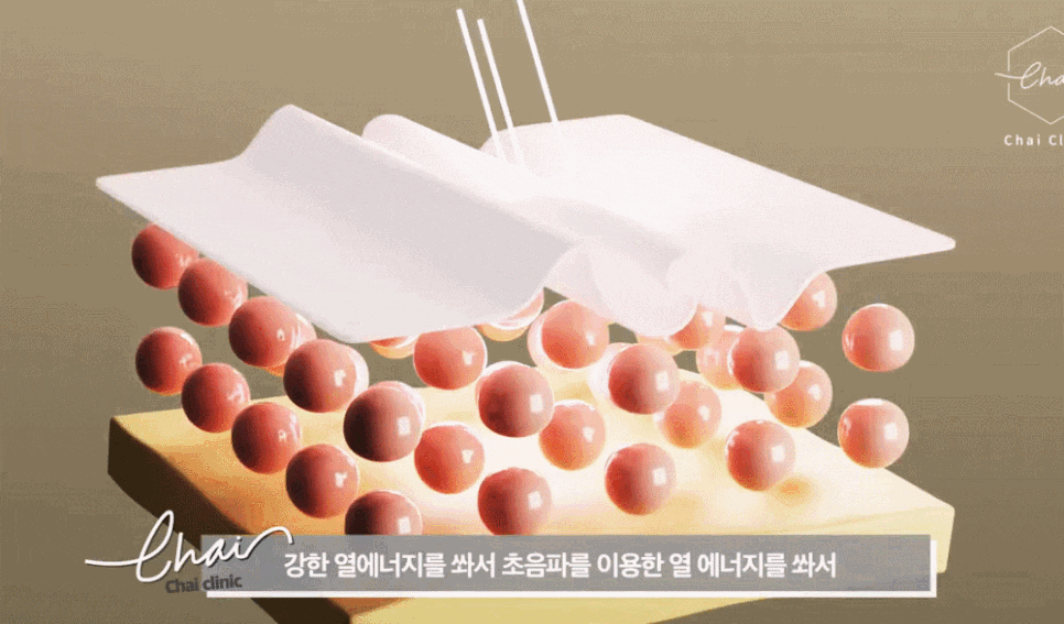 써마지600 후기가 궁금하다면 필독! 관련 이미지 9