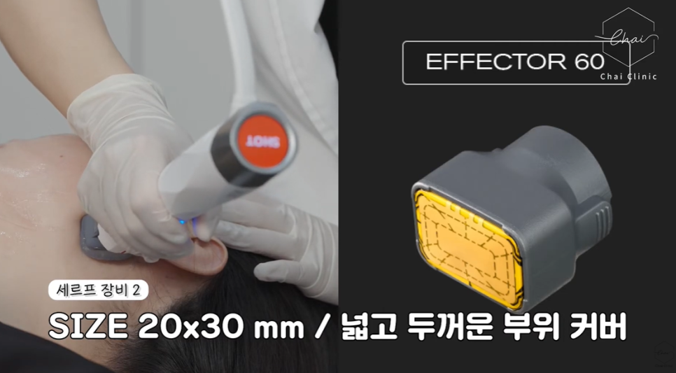 If You Get Celfer, the Cheaper Alternative to Thermage, You’ll Get the Most Out of It image 7
