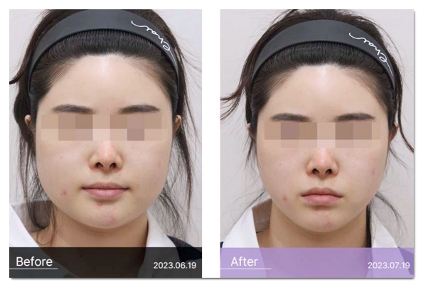 Mapo Botox: 3 Things to Check Before You Regret Getting It Cheap image 8