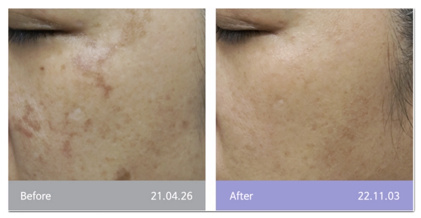 How Does Dual Toning Differ from Regular Laser Toning? image 8