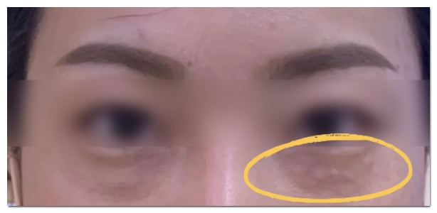 홍대 힐로웨이브 결절 부작용과 쥬베룩 눈밑 팔자에 괜찮을까 관련 이미지 2