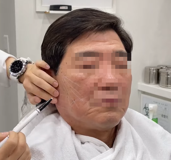 Avoid These 3 Types of Thread Lifting Side Effects in Hongdae image 7