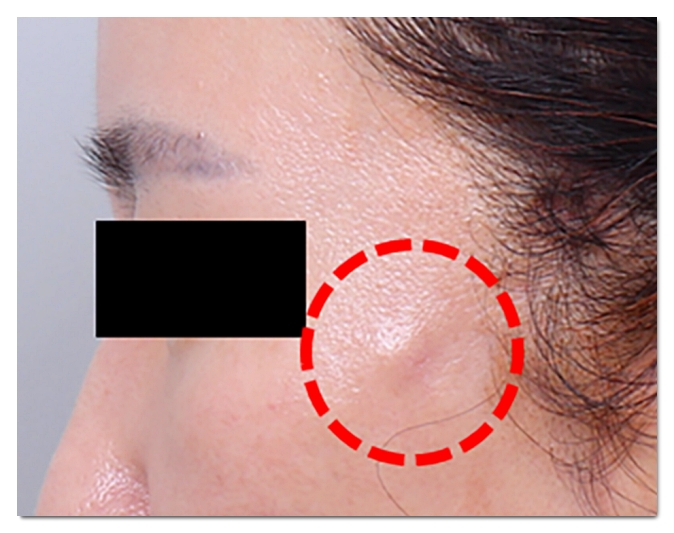 Avoid These 3 Types of Thread Lifting Side Effects in Hongdae image 2