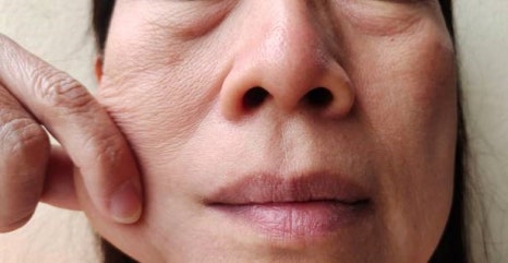 리쥬란힐러 주의사항, 이것만큼은 알아두세요 관련 이미지 6
