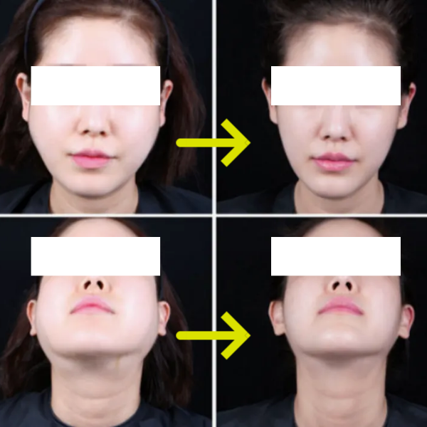 Read This Before You Regret Getting Salivary Gland Botox in Hongdae image 8