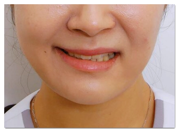 Why Can a Bad Chin Botox Injection Make Your Face Look Bigger in Hongdae? image 5