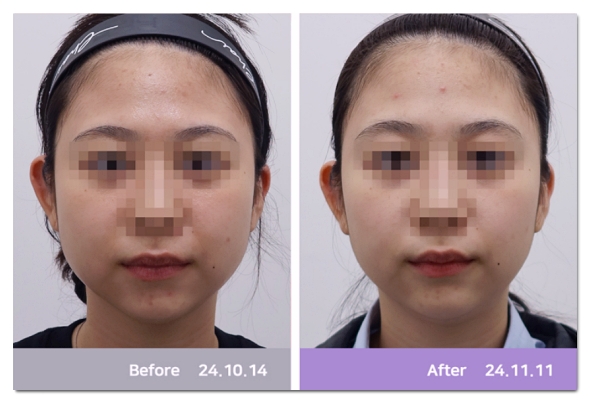 Hongdae Botox: How to Avoid Regretting Choosing a Clinic Just Because It’s Cheap (What to Look For) image 9