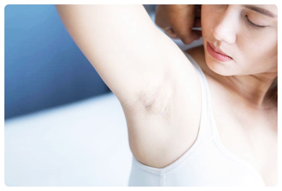 홍대 겨드랑이 제모 자국 없이 깨끗하게 관련 이미지 3