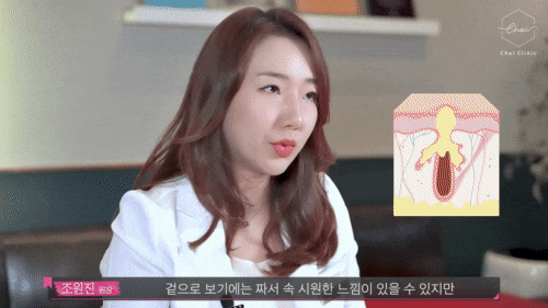 홍대 흉터치료 쥬베룩 피코레이저 어떤 효과가 있을까? 관련 이미지 3