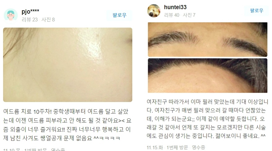 처진볼살리프팅 관련 이미지 18