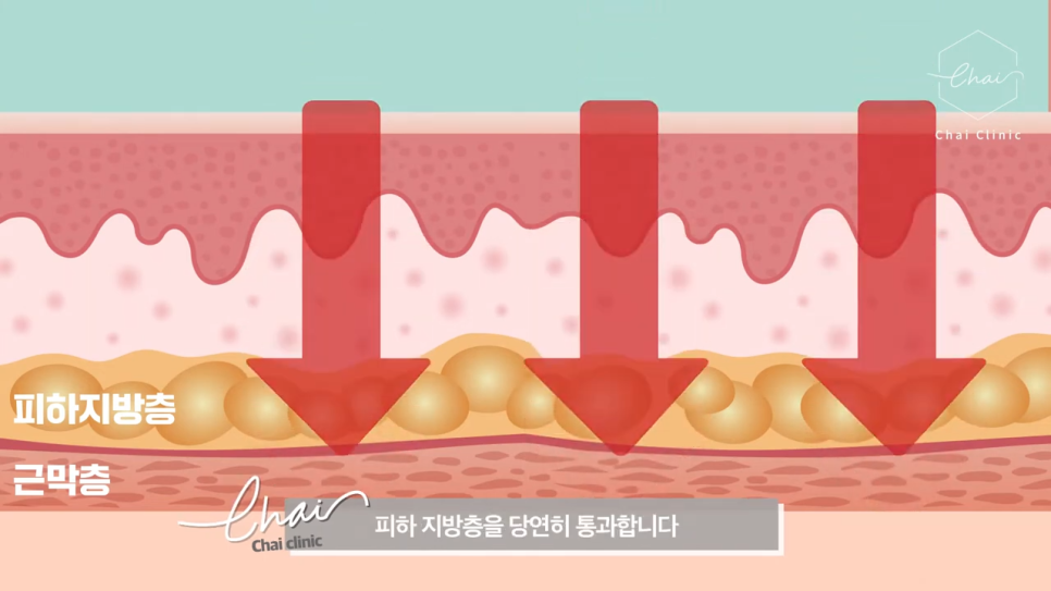 서교동 울쎄라 부작용 없이 시술하려면 관련 이미지 2