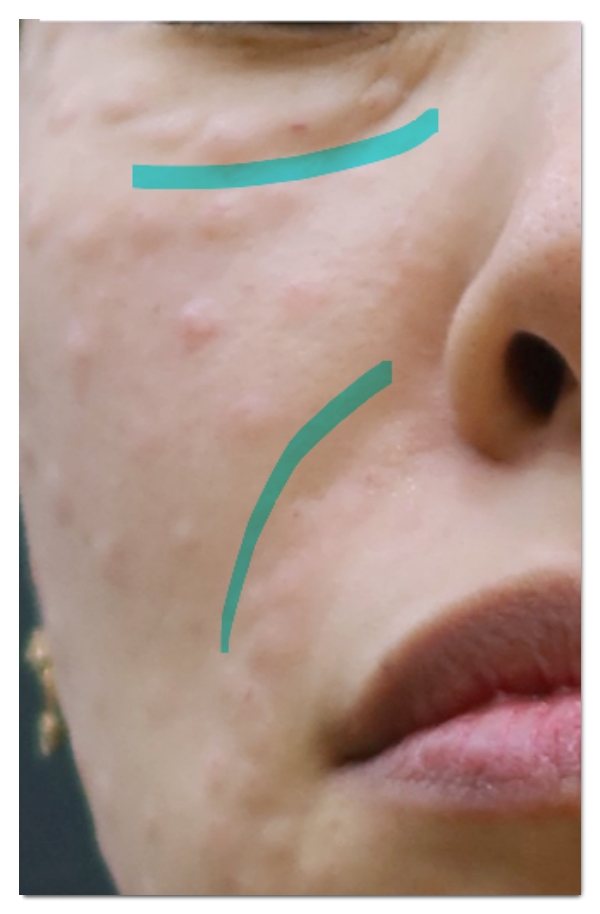 홍대 리쥬란 효과 못 본 분들이 놓친 3가지 관련 이미지 5
