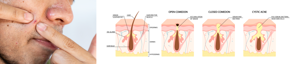 홍대피부관리 8년 노하우 여드름 치료방법은! 관련 이미지 3