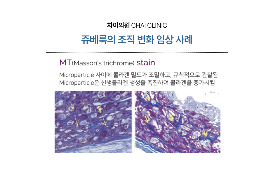 울퉁불퉁한 피부를 개선하는 쥬베룩 흉터 치료 관련 이미지 2