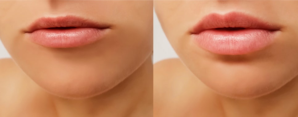 입술필러유명한곳 아직도 뀨 입술? 대세는 ‘이것’입니다 관련 이미지 4