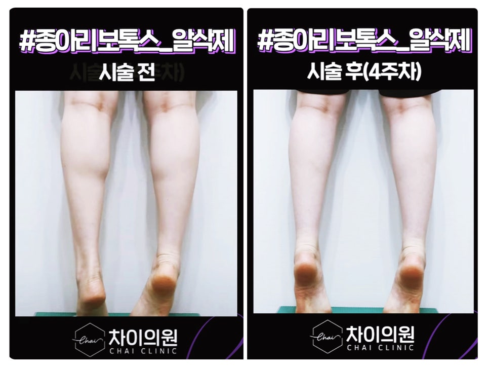 종아리보톡스 주기 언제가 적절할까요? 관련 이미지 7