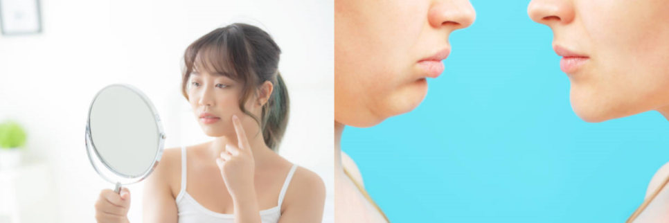 침샘보톡스가격 차이나는 이유와 효과, 진실 관련 이미지 5