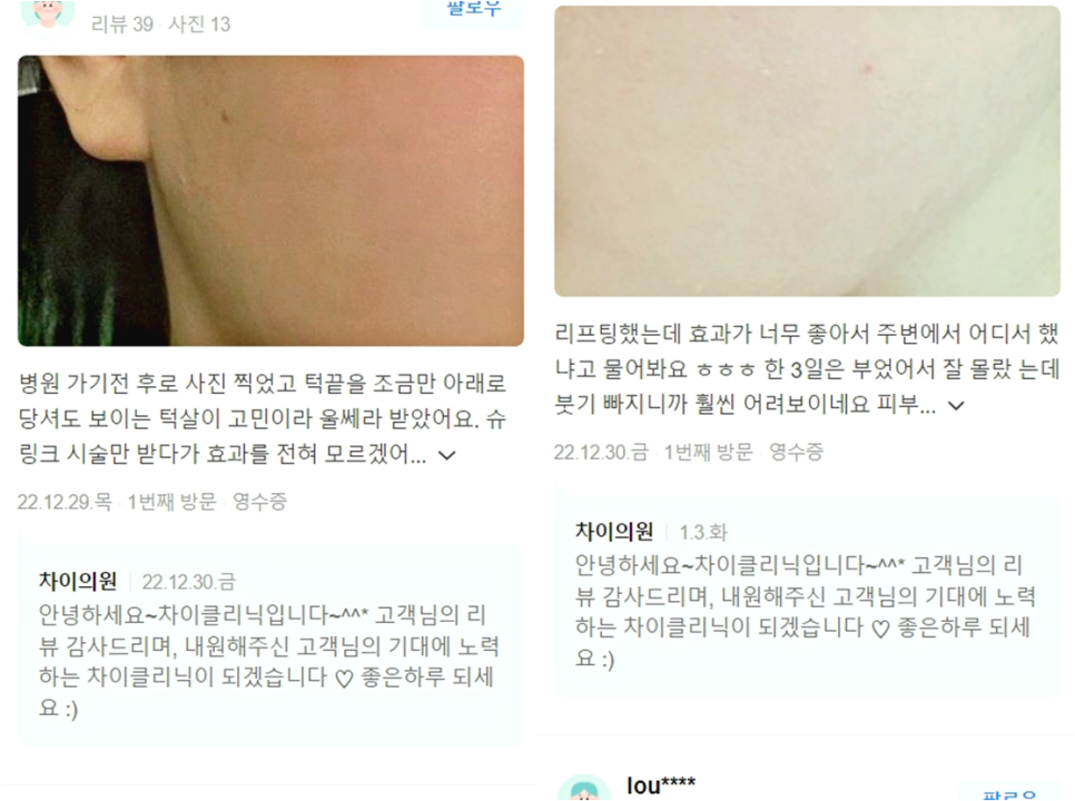 목리프팅 목주름을 확실하게 없애고 싶은 분들만 꼭 보세요. 관련 이미지 17