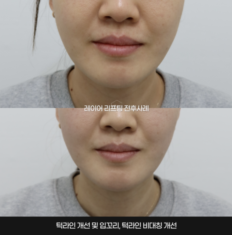 고주파 리프팅 종류와 차이의원의 리프팅 솔루션 관련 이미지 14