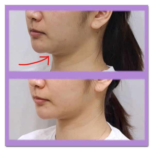 슈링크 효과 언제부터일까? 시기별 효과 및 유지기간 총정리 관련 이미지 7