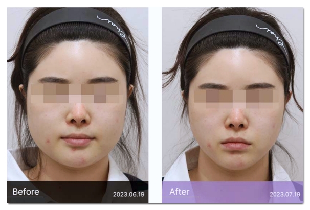 합정 보톡스 손해보지 않으려면 봐야할 3가지 관련 이미지 3