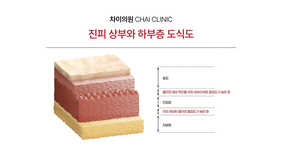 리쥬란 HB 통증에 대한 견해 관련 이미지 11