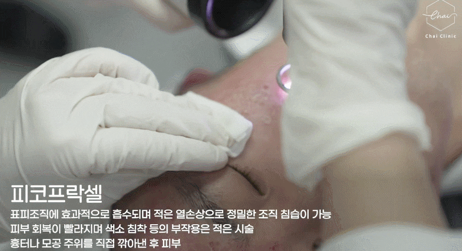 여드름흉터레이저가격, 돈 들여도 소용없는 이유 관련 이미지 14