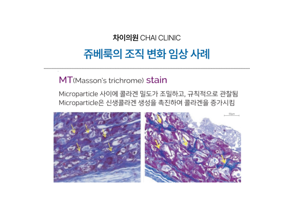 쥬베룩 볼륨 효과를 높이는 쥬베룩 리프팅 런칭! 관련 이미지 4