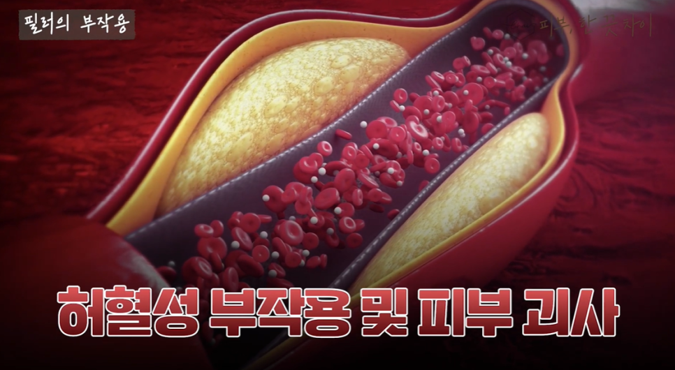 Three Steps to Prevent Filler Spreading, Migration, Necrosis, and Other Side Effects in Hongdae image 9