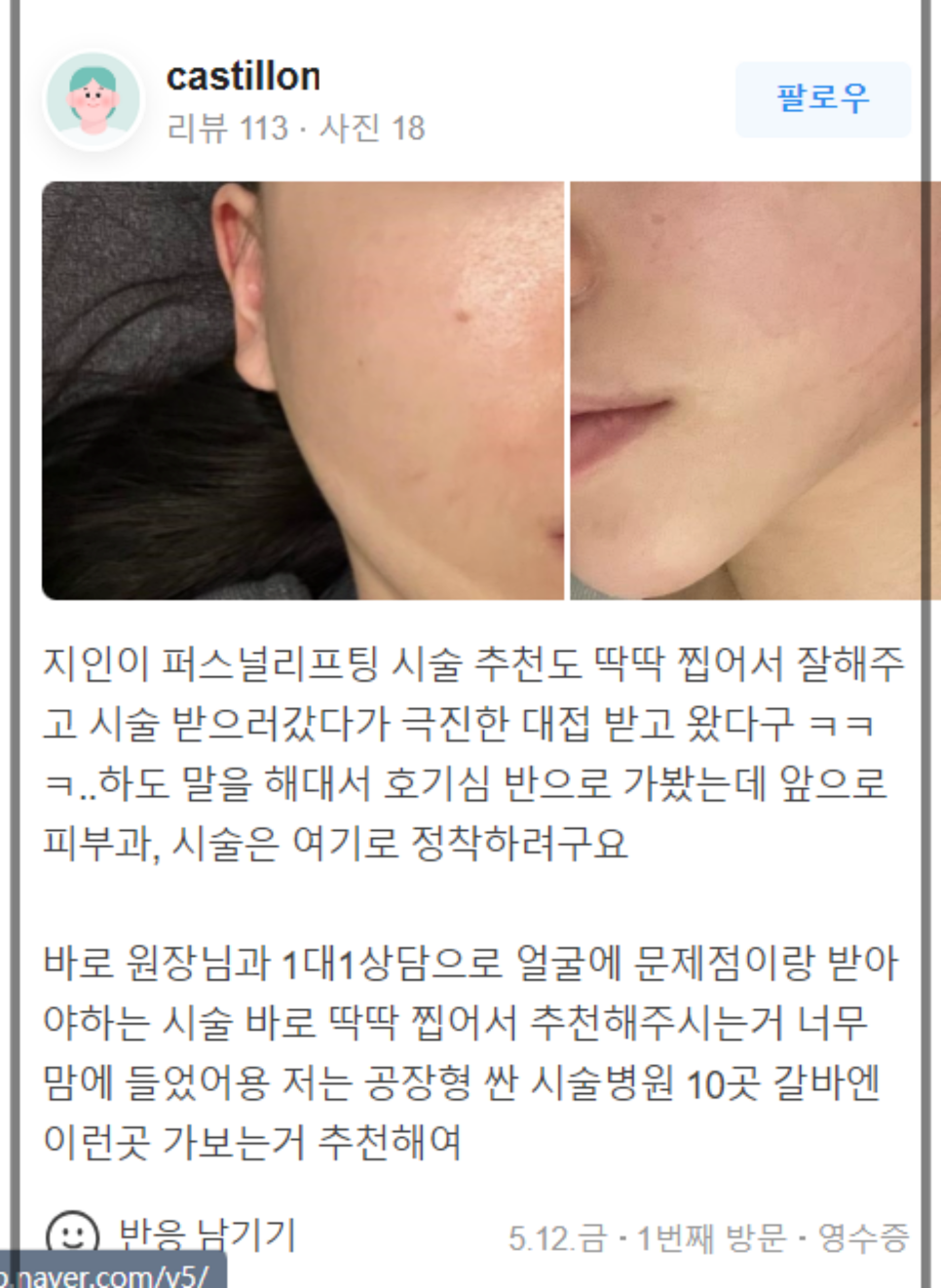 연어주사효과 리쥬란힐러에 대한 모든 것! 관련 이미지 10