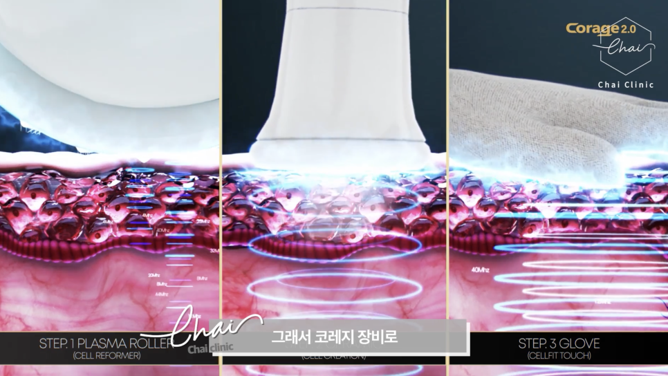 고주파 리프팅 종류와 차이의원의 리프팅 솔루션 관련 이미지 1